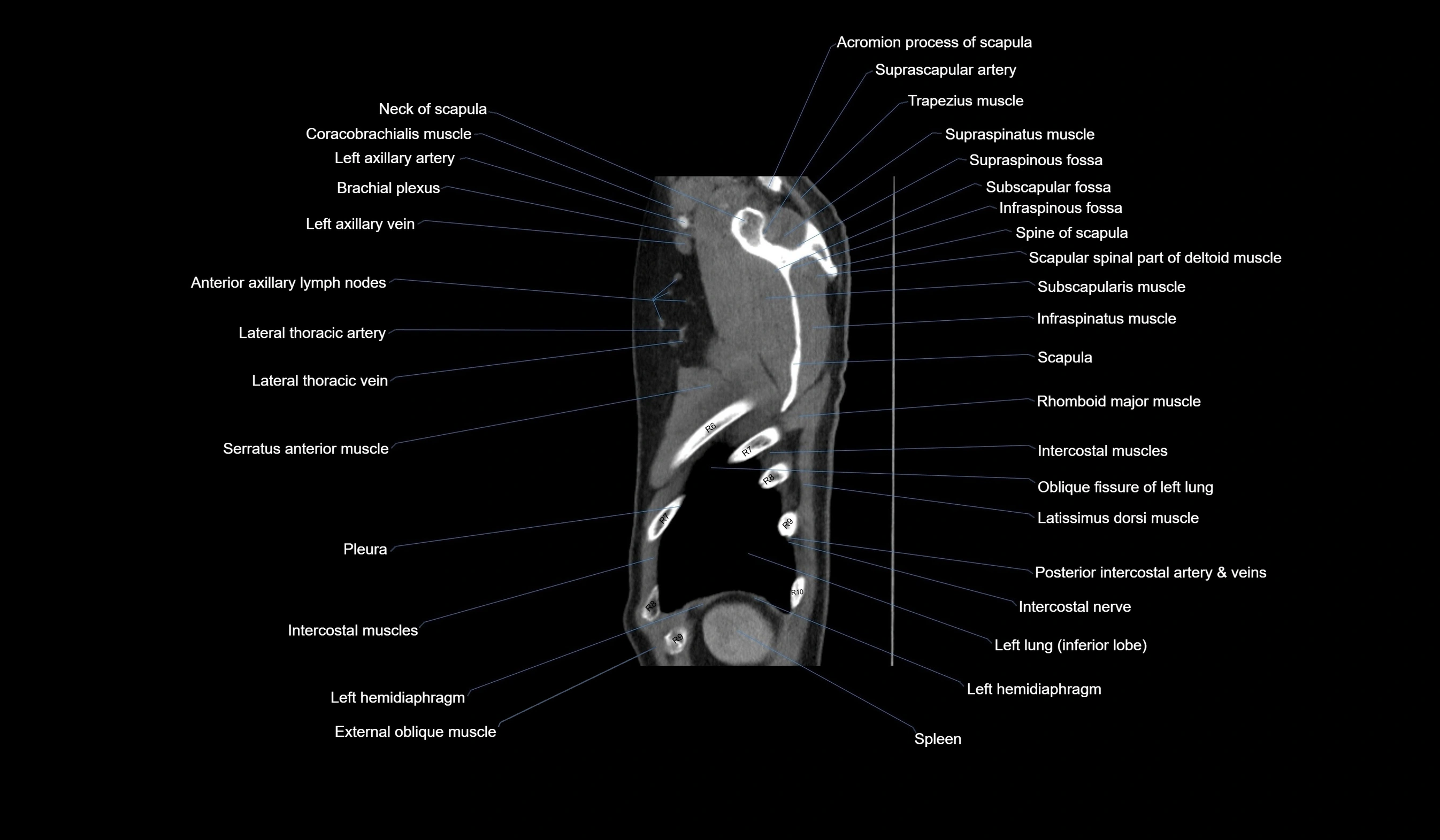 CT chest (thorax) soft tissue window labelled sagittal cross sectional anatomy radiology image-00129.webp